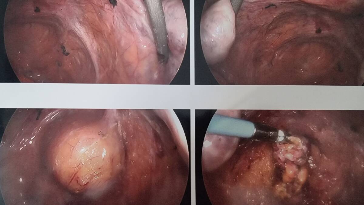Ms Bean shared images of cysts that were found in her uterus and ovaries during an operation where doctors planned to remove her appendix. Pictures: supplied 